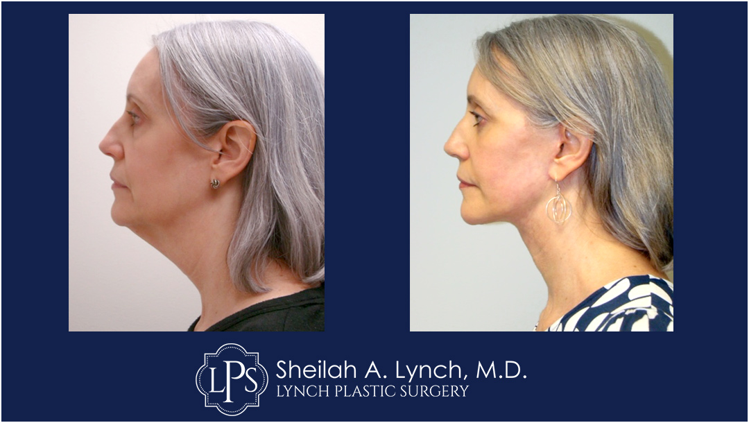 MACS Neck Lift Before & After Patient Chevy Chase Maryland. Plastic Surgeon Near Me Sheilah A. Lynch, MD