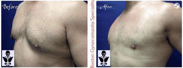 Images Boston Gynecomastia Specialists