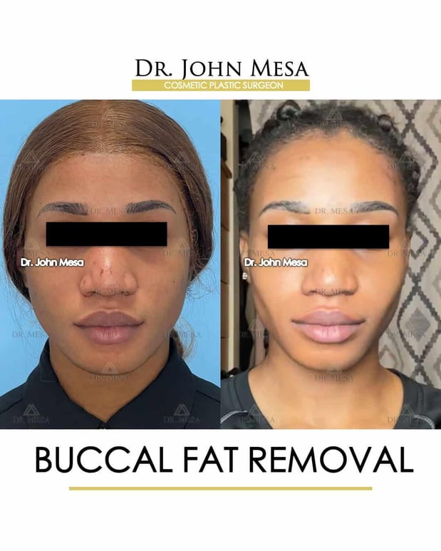 Images Dr. John Mesa, MD: Plastic Surgeon NYC, Buccal Fat Removal, Chin Liposuction, Facelift, Facial Masculinization, Chin Implant