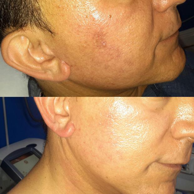 Scar Removal Treatment before and after 
407-622-2252 Wymore Laser