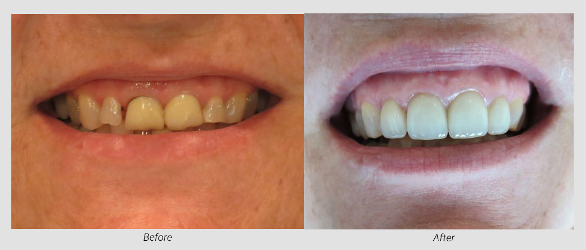 Smile Makeover Before & After at Lamendola Dentistry | Gonzales, LA