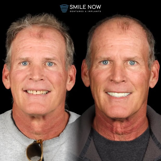 Images Smile Now Tacoma Dentures and Implants