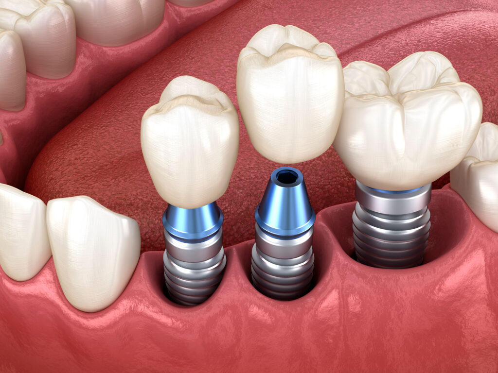 Implantatberatung - Zahnarztpraxis Stefan von Ostranitza |  Zahnarzt Zahnersatz Parodontologie | München