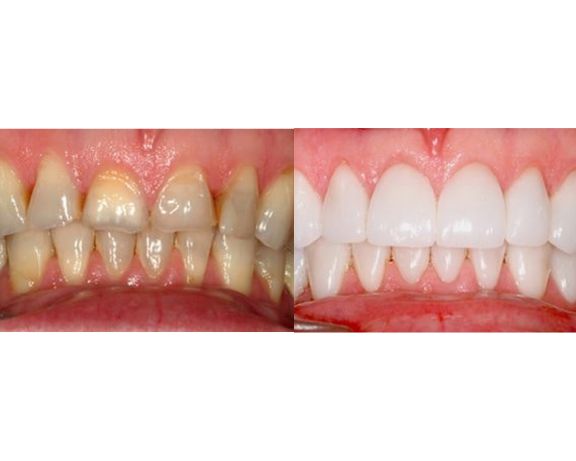 Before & After Results at Thompson Dental | Muskego, WI