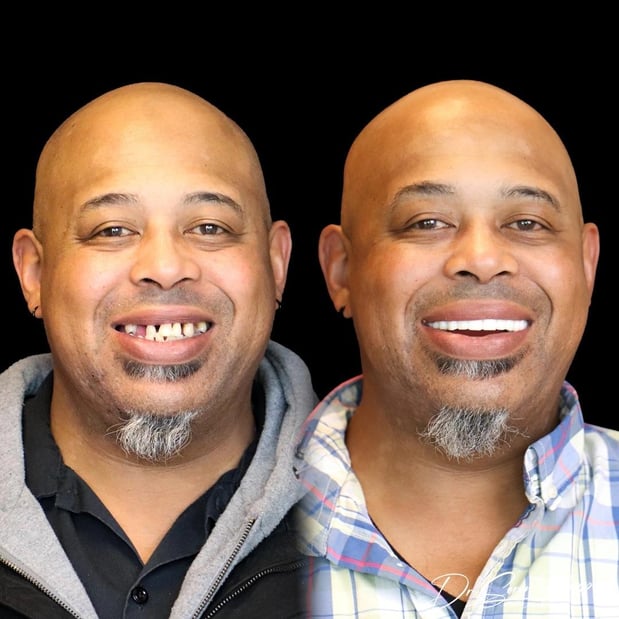 Images Smile Now Denver Dentures and Implants