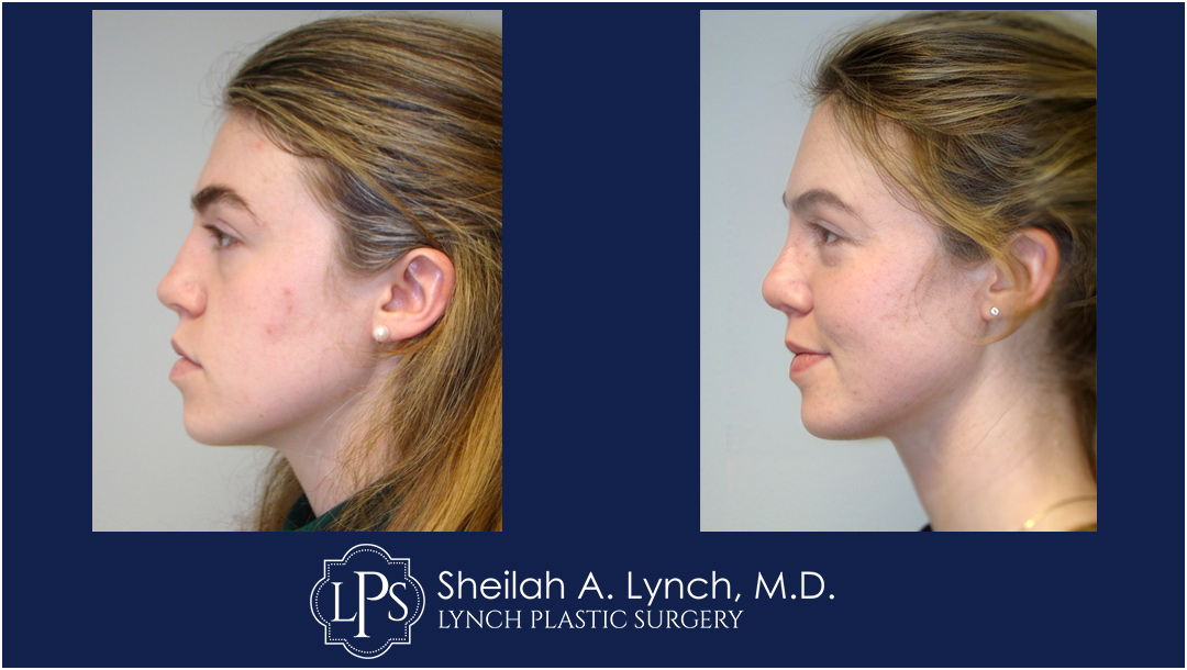 Rhinoplasty, Nose Reshaping Before & After Patient Chevy Chase Maryland. Plastic Surgeon Near Me Sheilah A. Lynch, MD