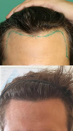 Images BKS Hair Restoration