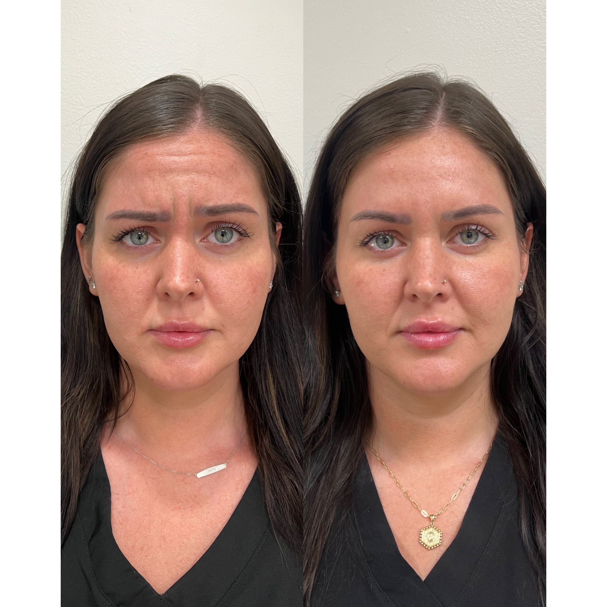 Before and after facial results, Care Esthetics Delaware