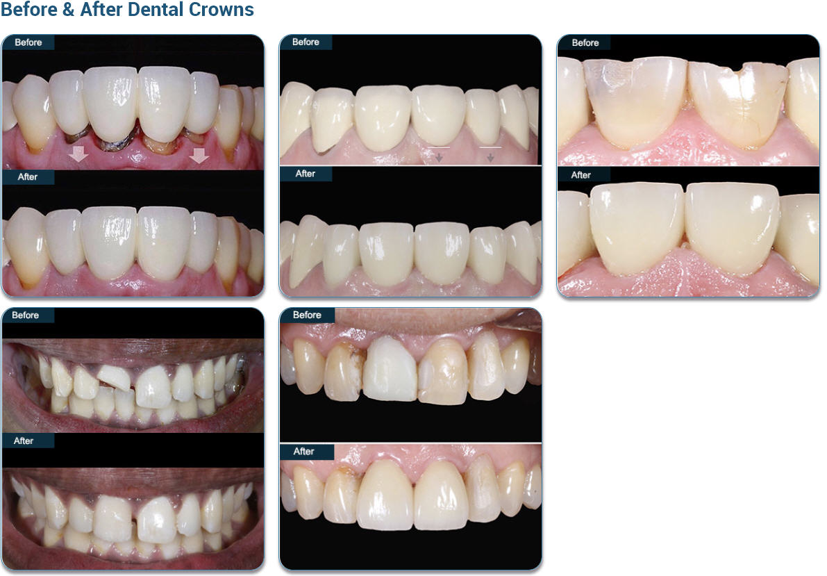 Before & After Dental Crowns