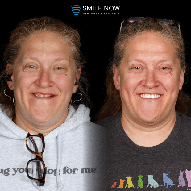 Images Smile Now Milwaukee Dentures and Implants