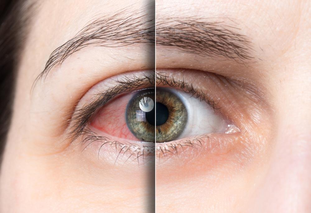 red eye before and after