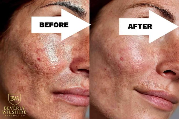 Images Beverly Wilshire Aesthetics Beverly Hills Medical Spa for Botox, Morpheus8, IPL, Lip Fillers