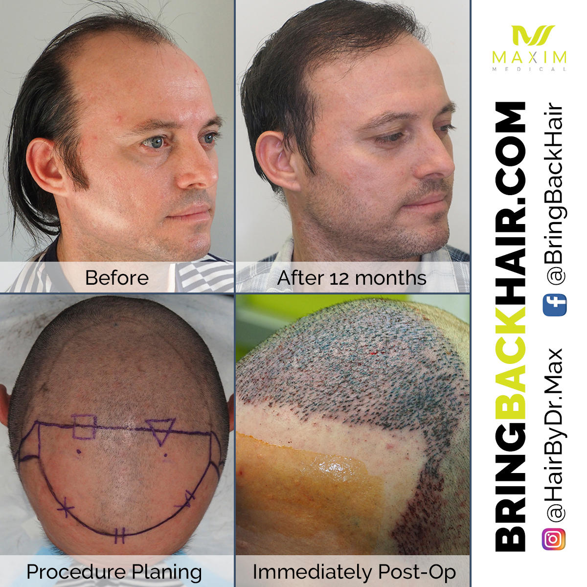 ARTAS robotic technology revolutionizes hair restoration. Here are the results of Carlos, an ARTAS patient who achieved their dream results. Using ARTAS robotic technology, Dr. Chumak helped restore Carlos’ hair to its full vitality. Want your hair back too? Visit our website to see just how at www.bringbackhair.com , along with other testimonials