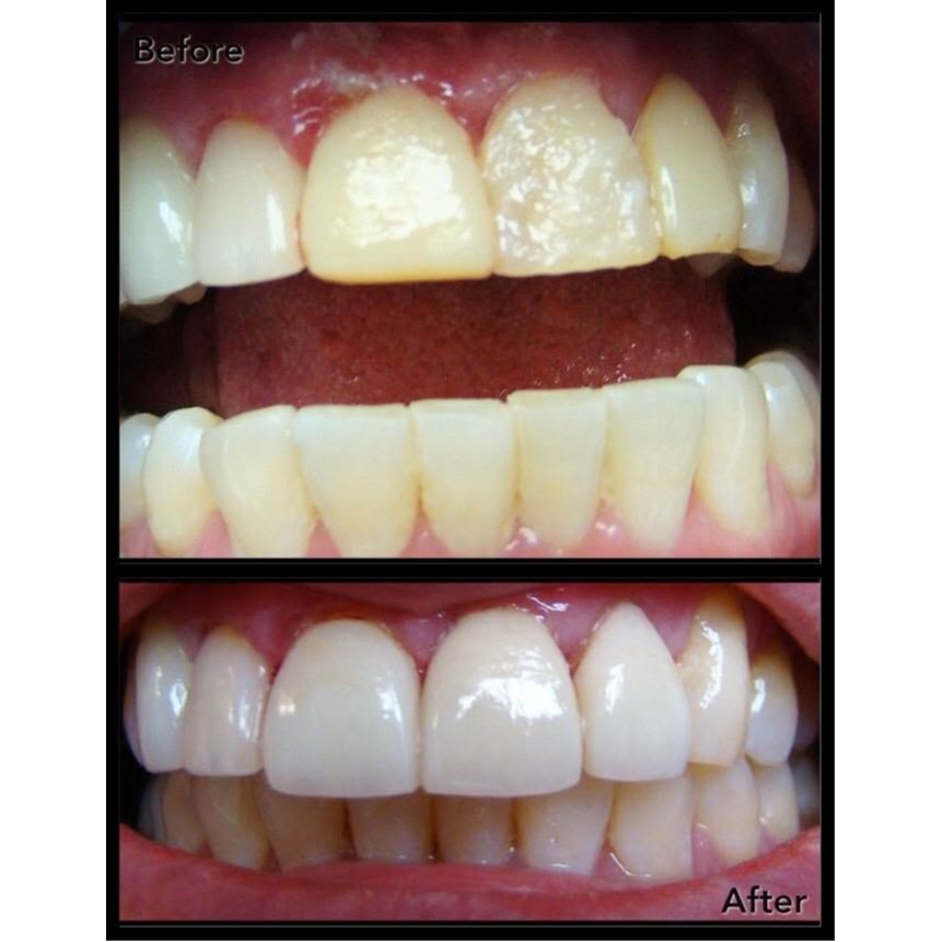 Before-and-after smile enhancement showing improved shape, color, and symmetry of the upper front te 