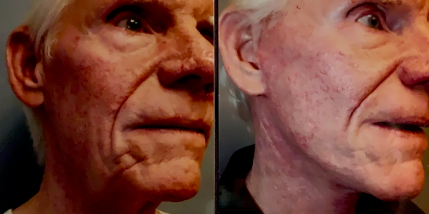 Before & After from Steven H. Wiener, MD: New Image Plastic Surgery | Scottsdale, AZ