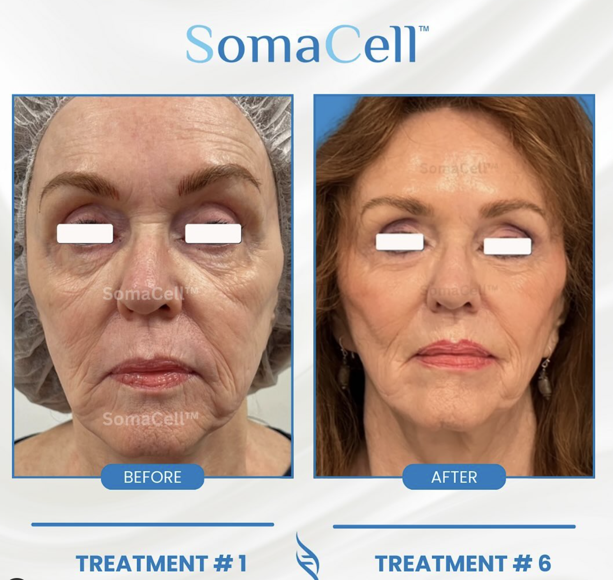 somacell before and after