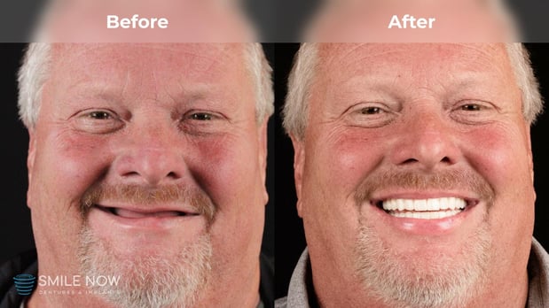 Images Smile Now Milwaukee Dentures and Implants