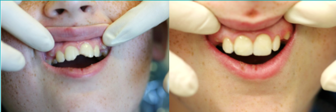 Before & After Results at The Office of Keith G. Lorio, DDS| Baton Rouge, LA