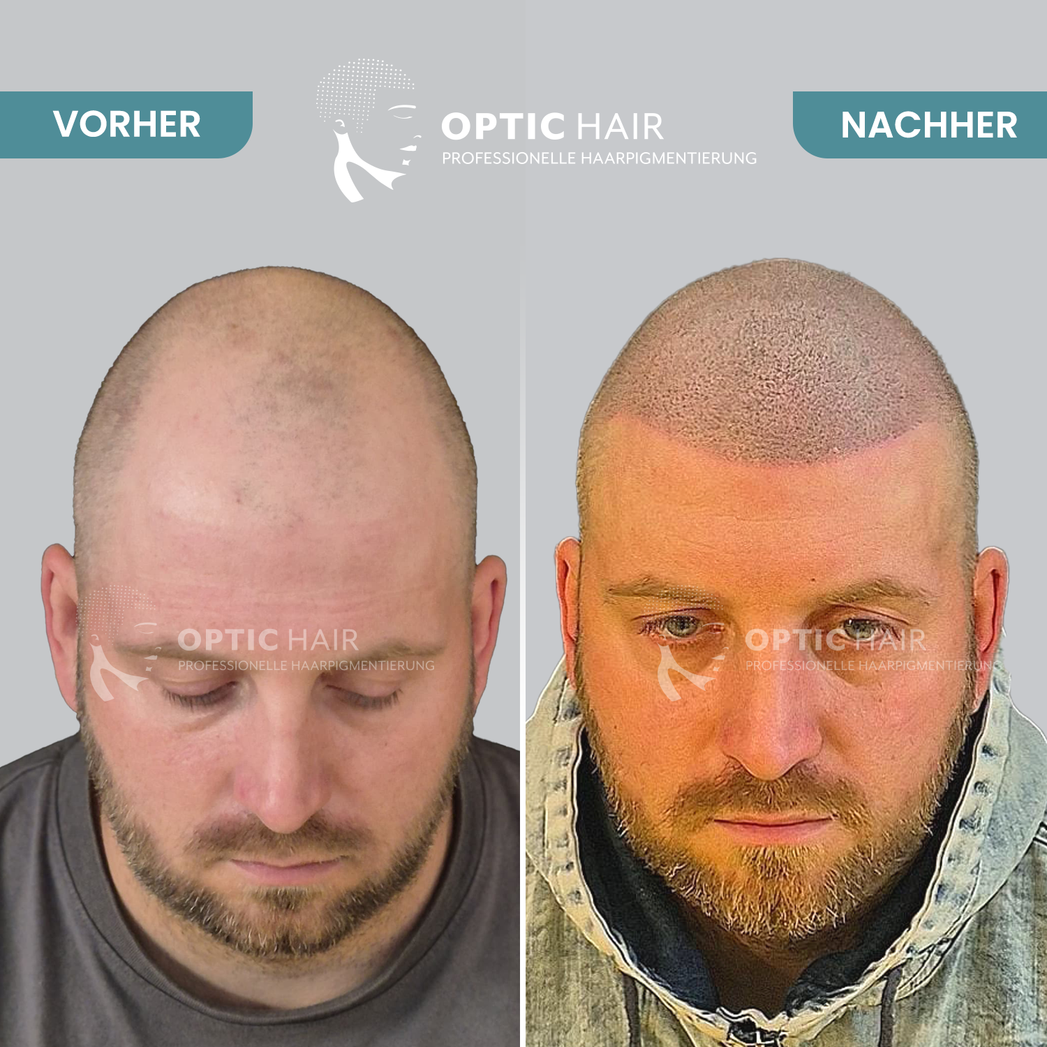 Kundenbild groß 5 Haarpigmentierung Köln | OpticHair