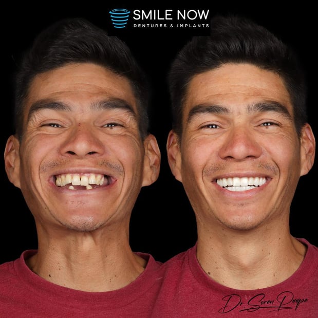 Images Smile Now Denver Dentures and Implants