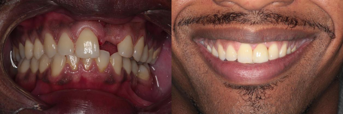 Before & After from Southern Dental Implant Center | Cordova, TN