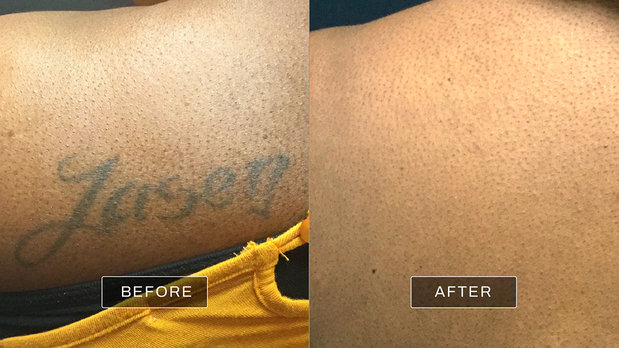 Images Removery Tattoo Removal & Fading