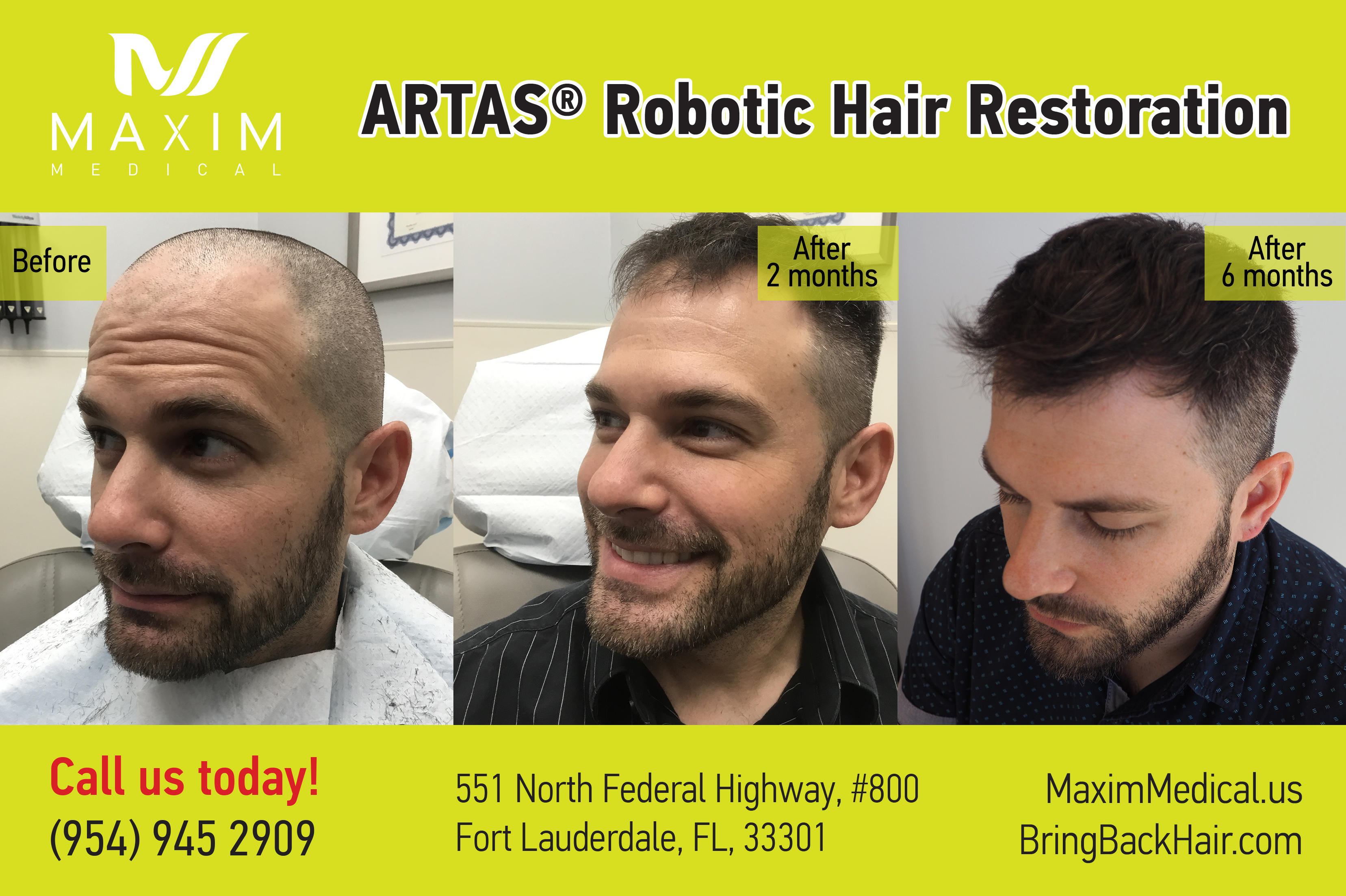 Before&After ARTAS robotic hair transplant surgery. 
Real people - real results!