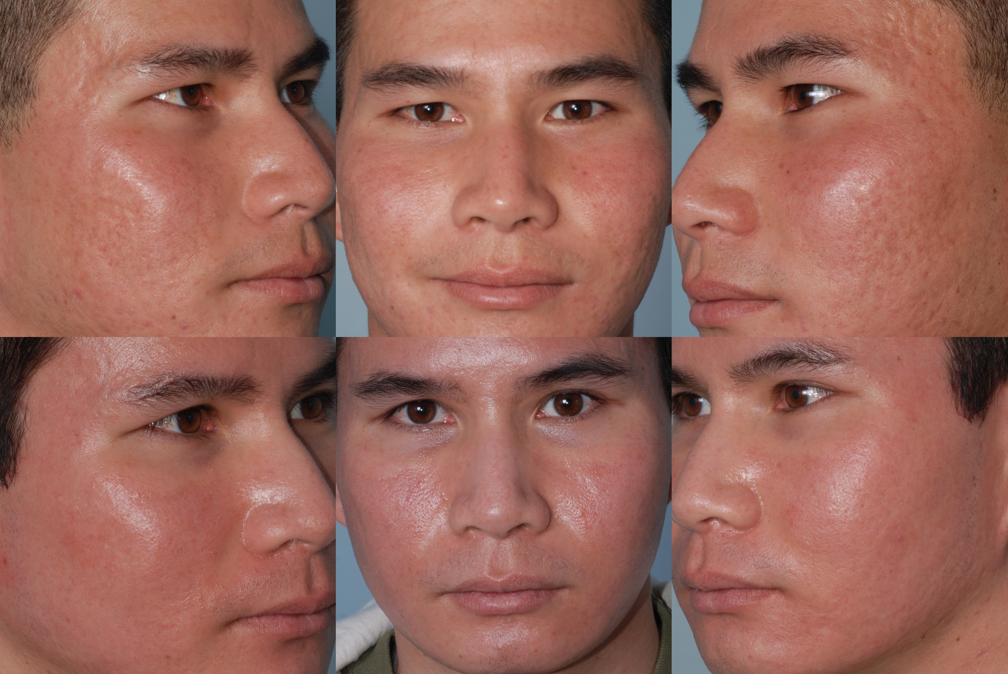Acne scars treated with a single combination treatment invented by Dr. Mark Taylor using a subcision tool invented by Dr. Mark B. Taylor, MD owner of the Gateway Aesthetic
