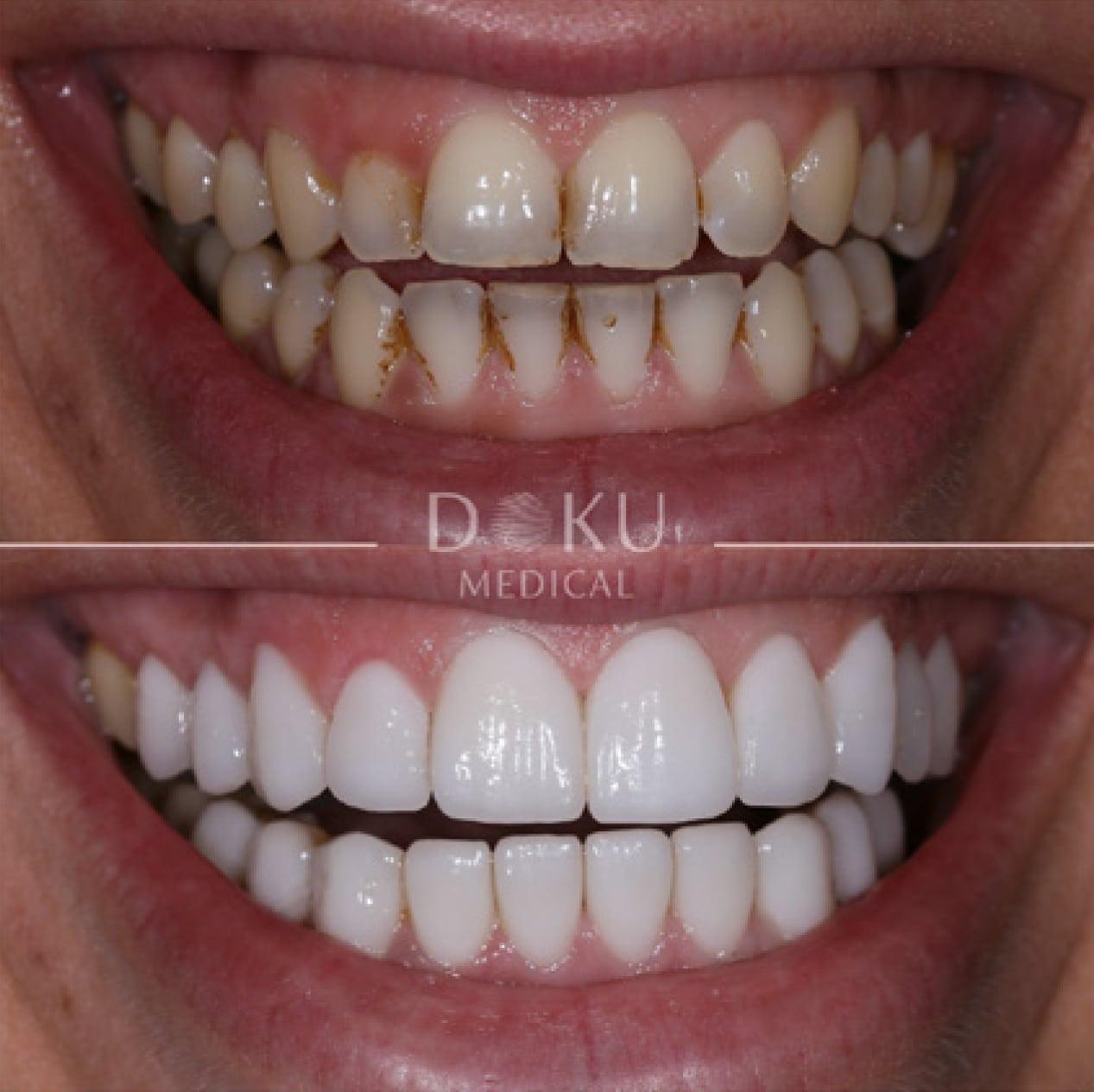 Bild 3 Veneers & Zahnimplantate – Zähne machen lassen in der Türkei mit Fly2Smile in Berlin