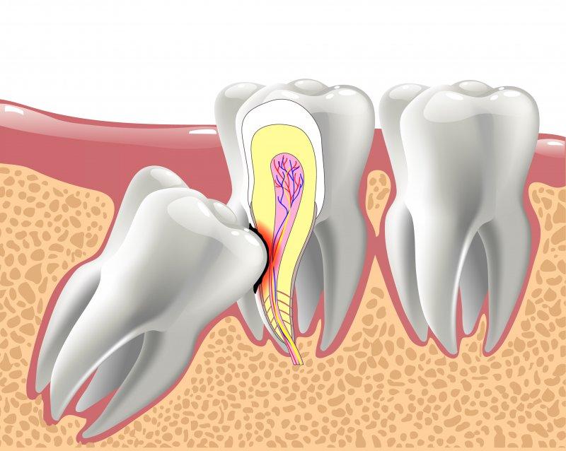 Images Wisdom Teeth Factory - Houston