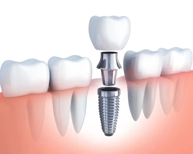 Images Best Value Dentures and Implants Palmetto Bay