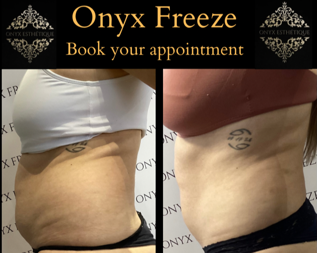 Images Onyx Esthétique - Soins esthétiques, Soins de la peau, Laser Cynosure Gatineau