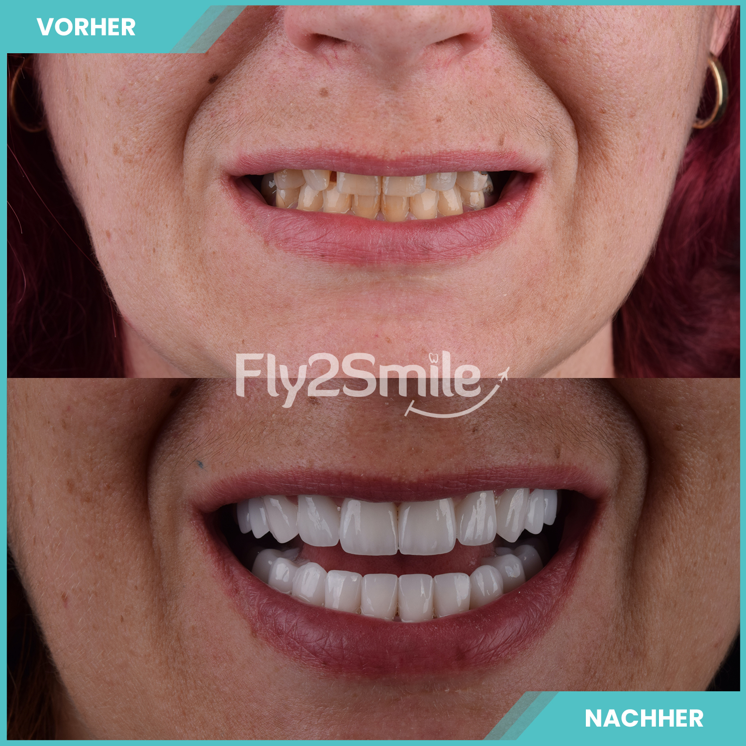 Kundenbild groß 13 Veneers & Zahnimplantate – Zähne machen lassen in der Türkei mit Fly2Smile