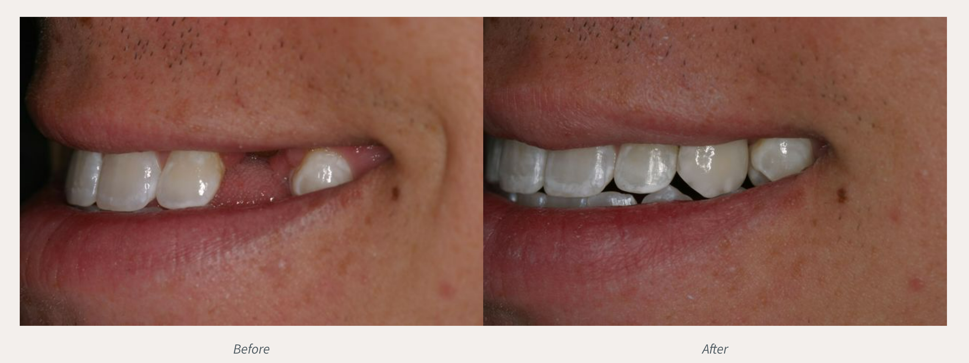 Dental Implant Before & After from Advanced Dental Care | Valdosta, GA