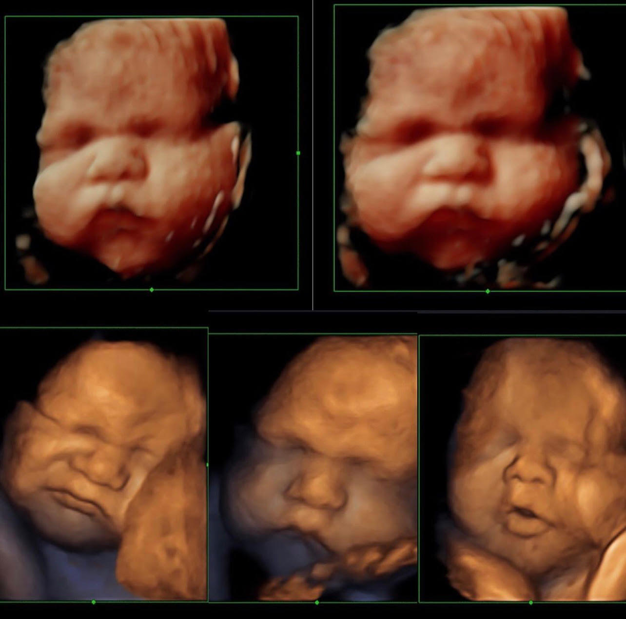 Image 5 | Belly 2 Birth 3D 4D Ultrasound