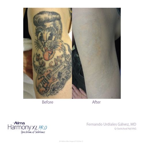 ClearLift Tattoo Removal