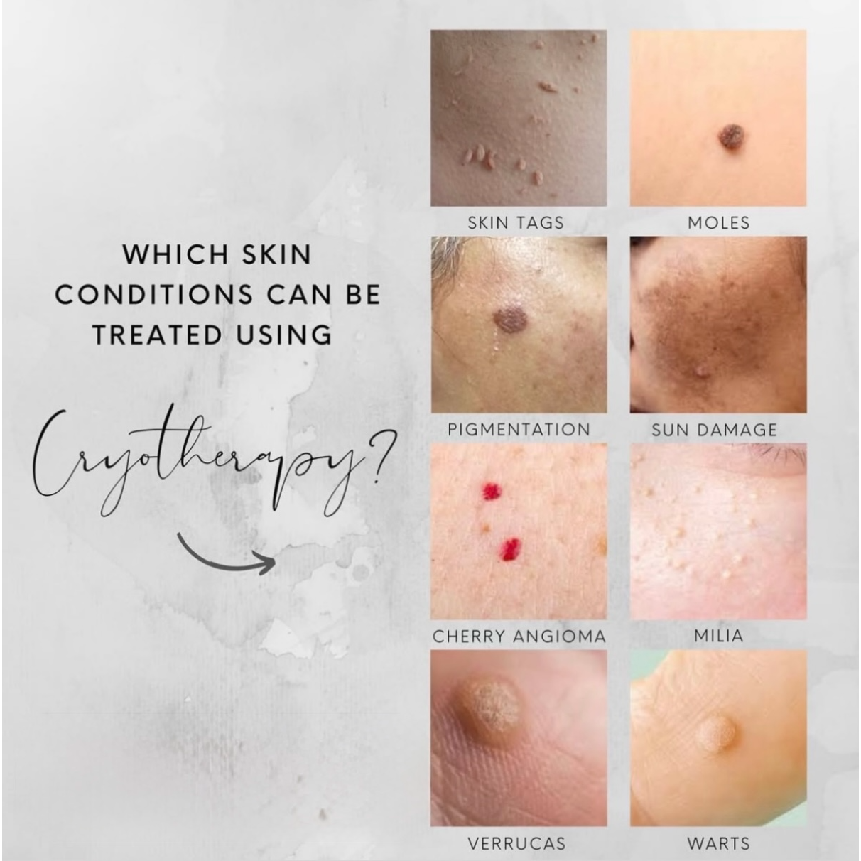 Cryotherapy skin condition information image for KWJ Skin Clinic, an aesthetic clinic in Horsham offering cryotherapy for skin tags, sunspots, pigmentation, blemishes and minor skin lesions.