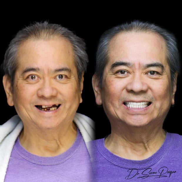 Images Smile Now Denver Dentures and Implants