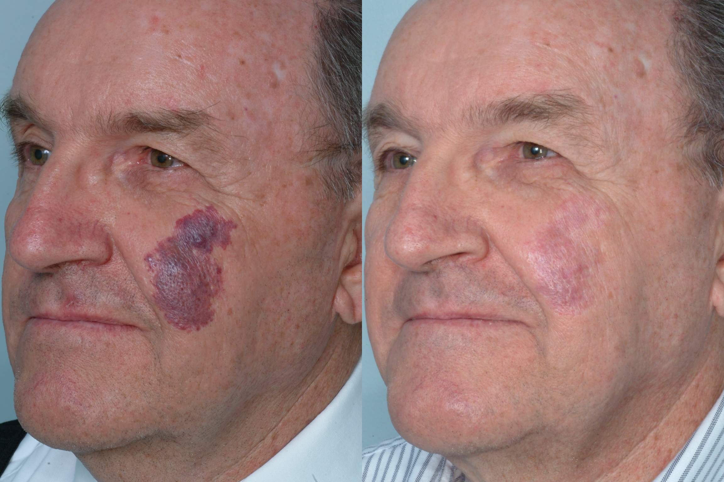 Adult hypertrophic port wine stain treated using a fractional long-pulse Nd-YAG Laser procedure invented by Dr. Mark Taylor, MD, a board certified dermatologist and owner of the Gateway Aesthetic Institute and