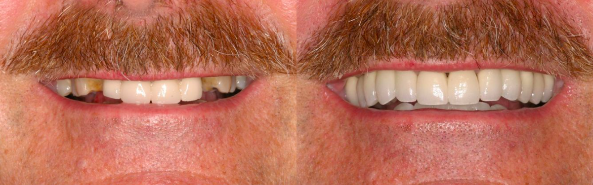 Before & After from Sonoran Dental Design | Scottsdale, AZ, , Dentist
