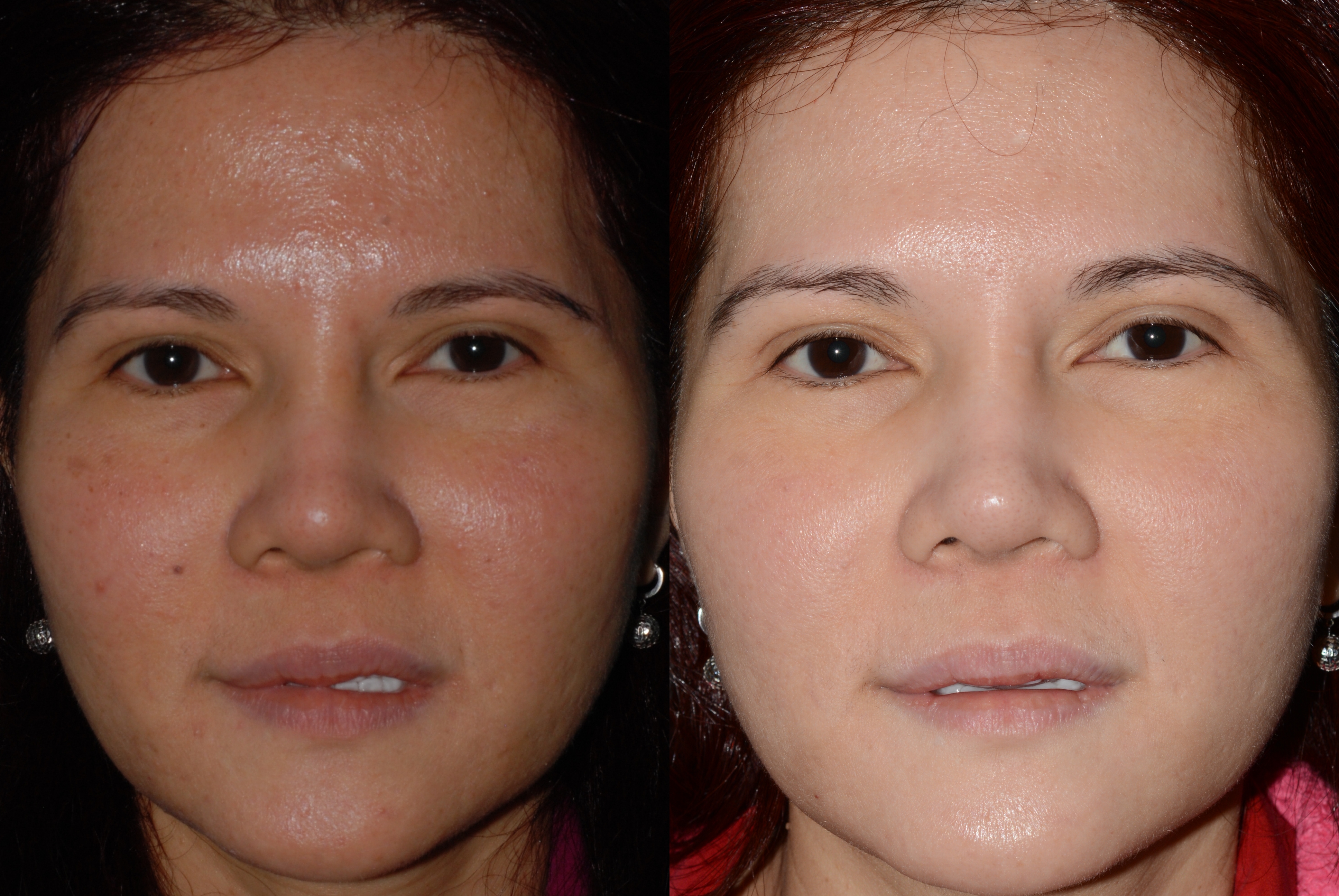 PicoFacial treatment of uneven pigmentation in Asian skin
