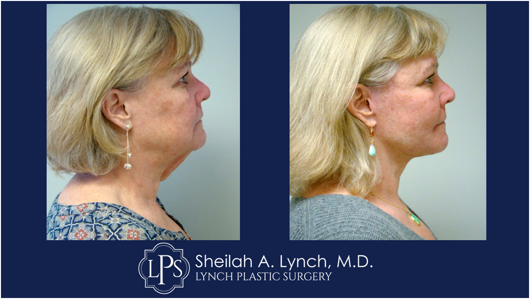 Neck Lift Before & After Patient Chevy Chase Maryland. Plastic Surgeon Near Me Sheilah A. Lynch, MD