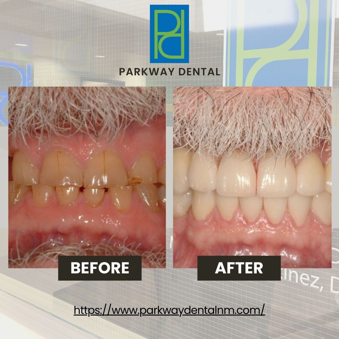 Before and after at Parkway Dental: Michael D Haight, DDS | Albuquerque, NM Parkway Dental: Michael D Haight, DDS Albuquerque (505)298-7479