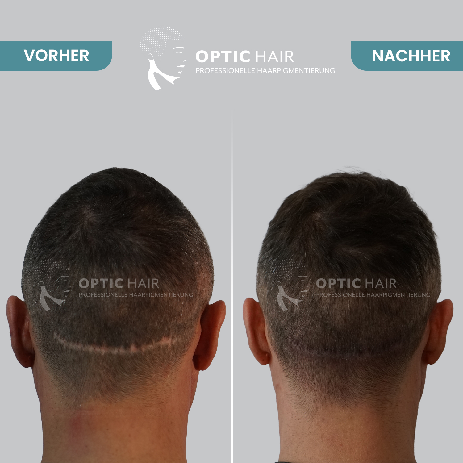 Kundenfoto 1 Haarpigmentierung Köln | OpticHair