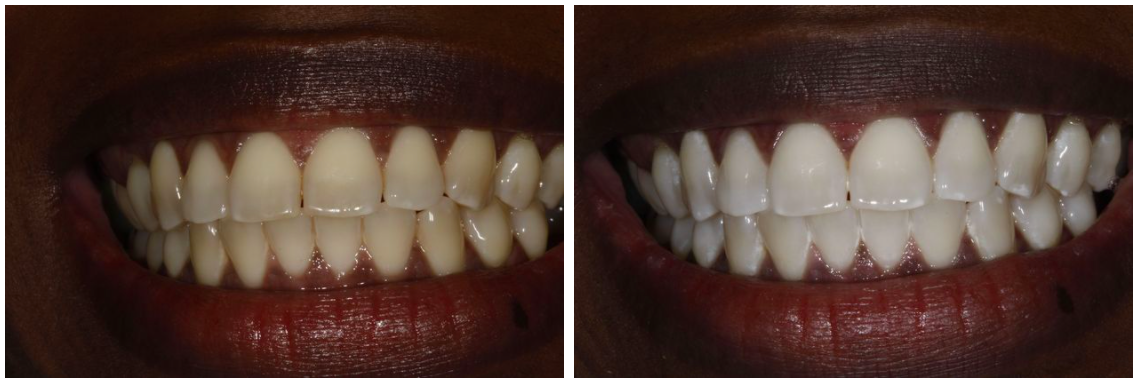 Before & After from Brooklyn Heights Dental | Brooklyn, NY
