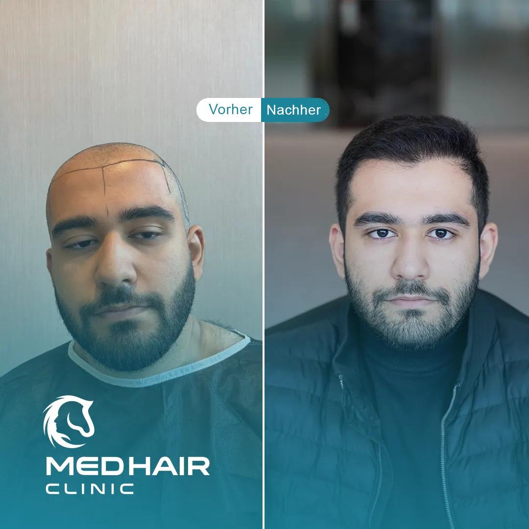 MedHair Clinic | Haartransplantationen in der Türkei Istanbul, Höninger Weg 176 in Rodenkirchen