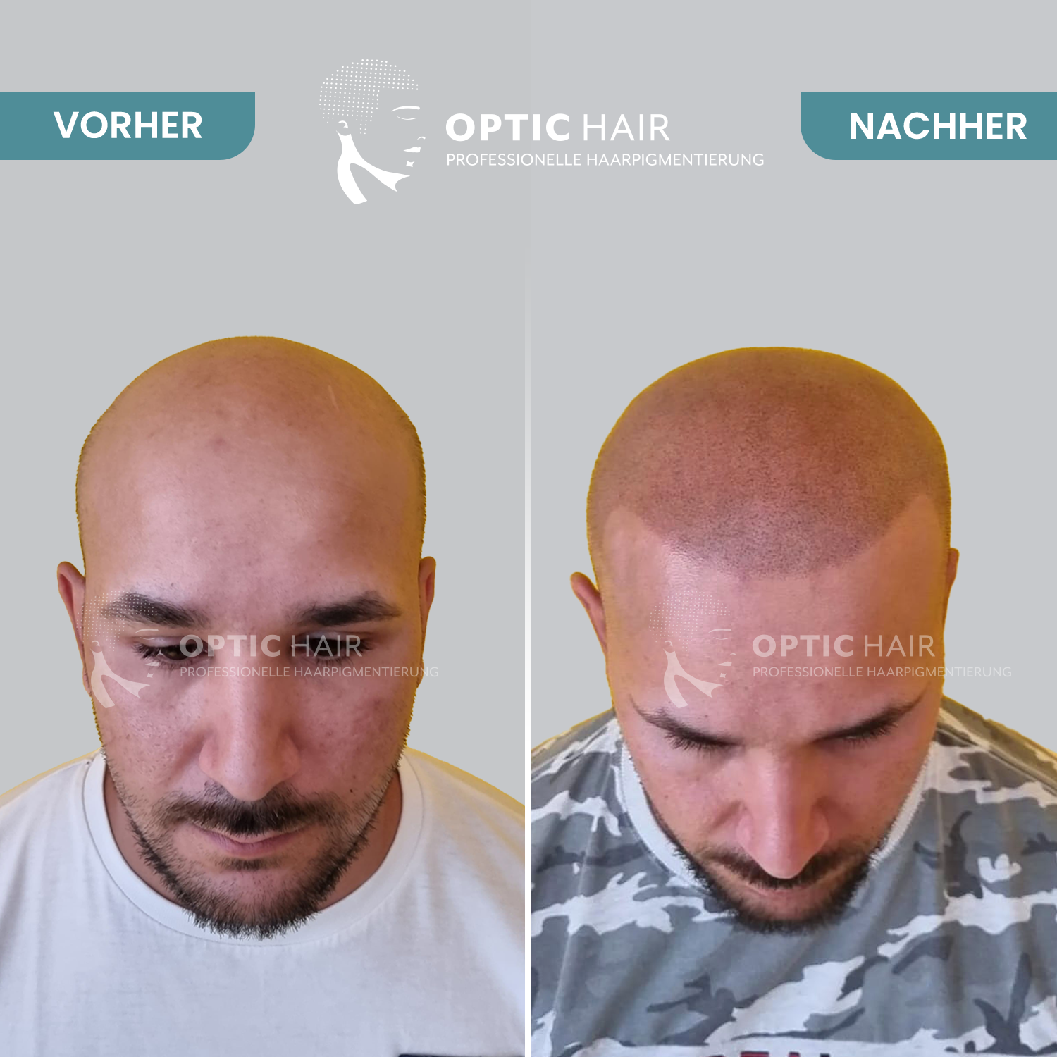 Kundenfoto 42 Haarpigmentierung Köln | OpticHair