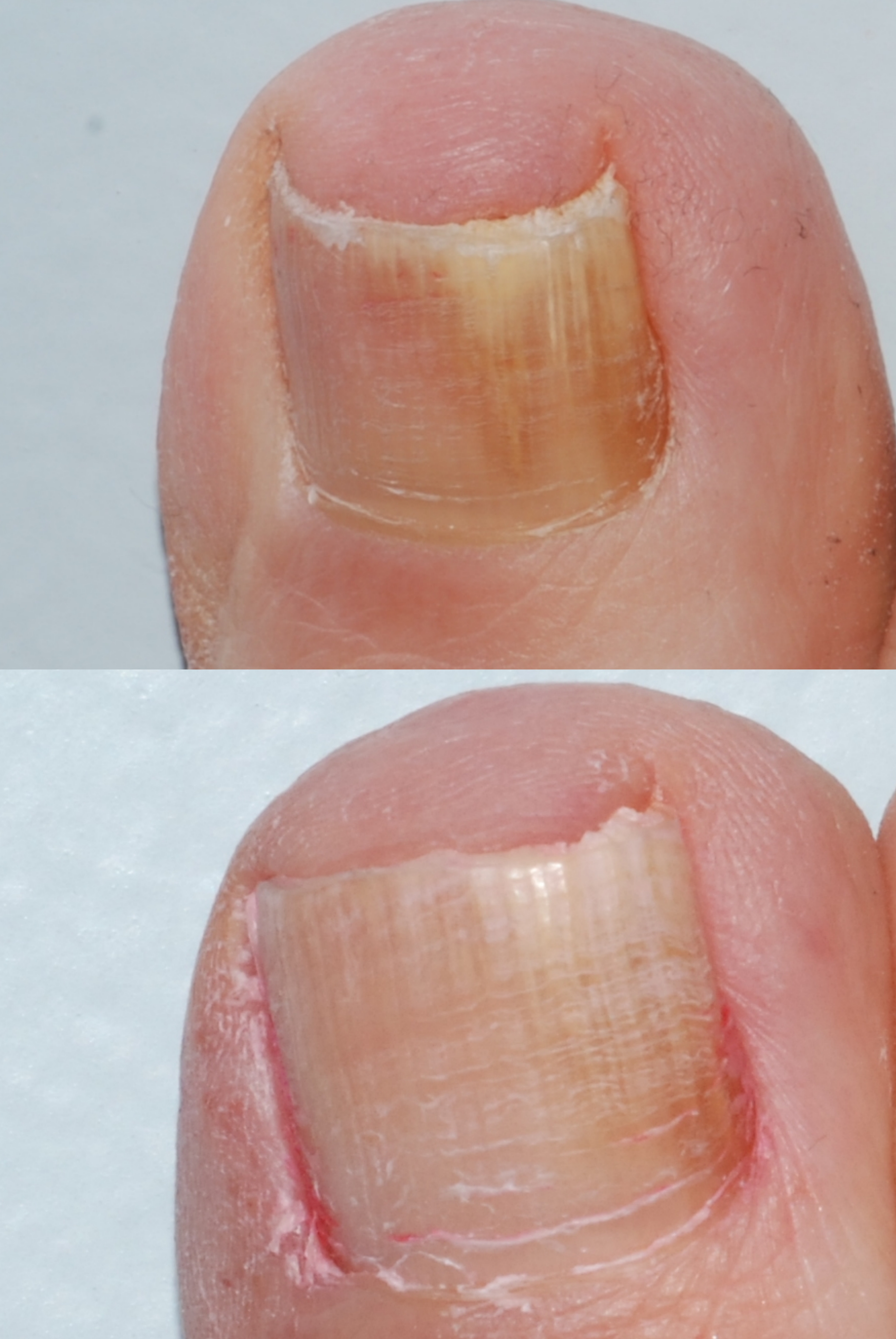 treatment of toenail fungus with laser