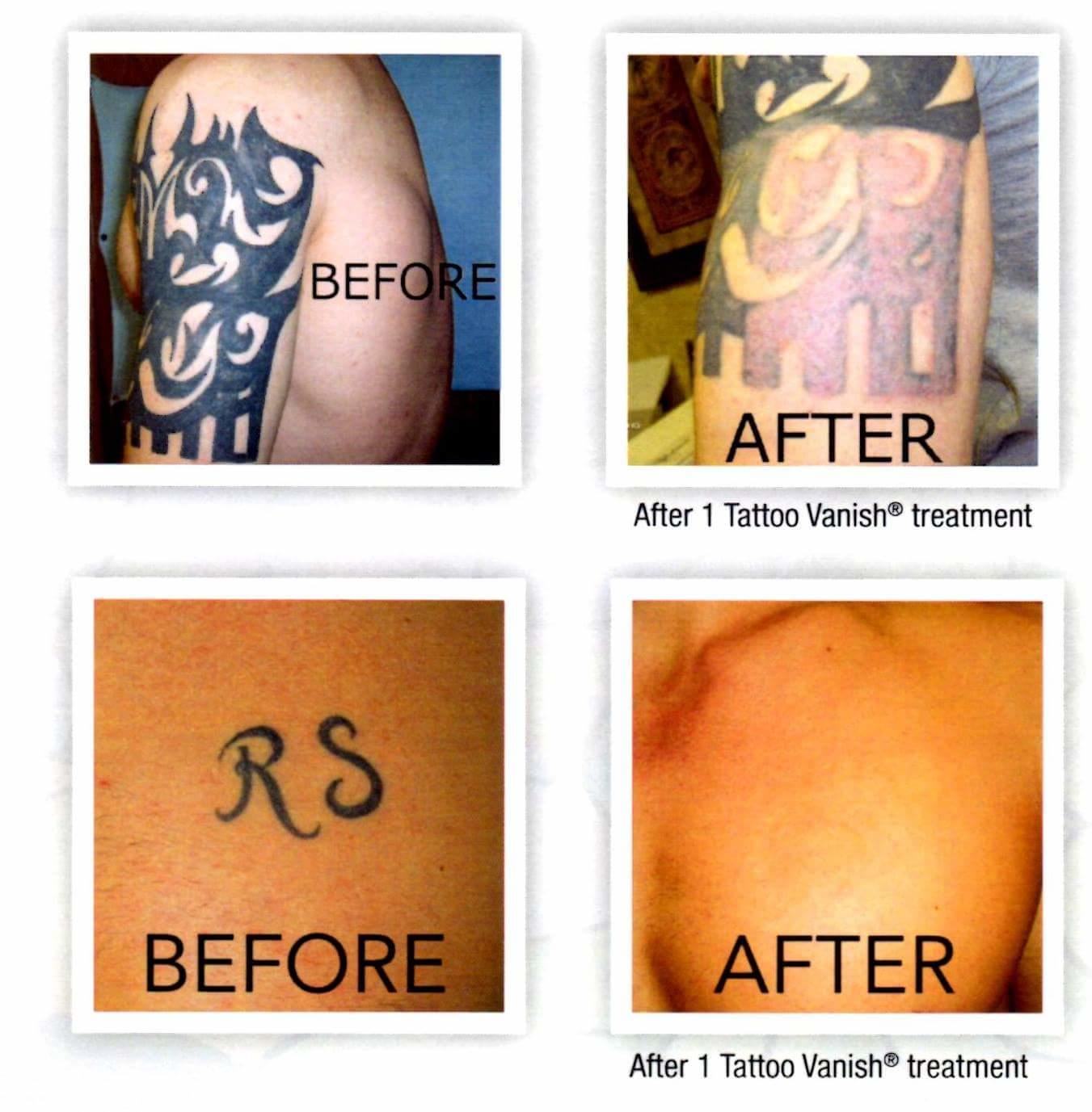 Tampa Tattoo Vanish, Inc in Tampa, FL 33613 