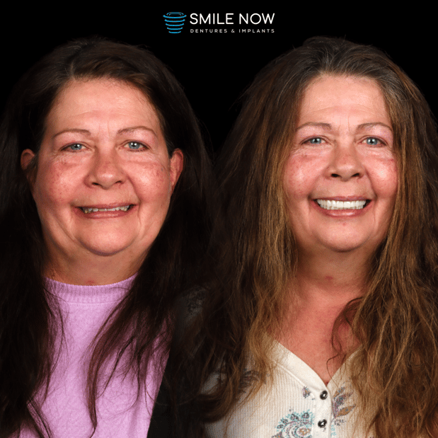 Images Smile Now Colorado Springs Dentures and Implants